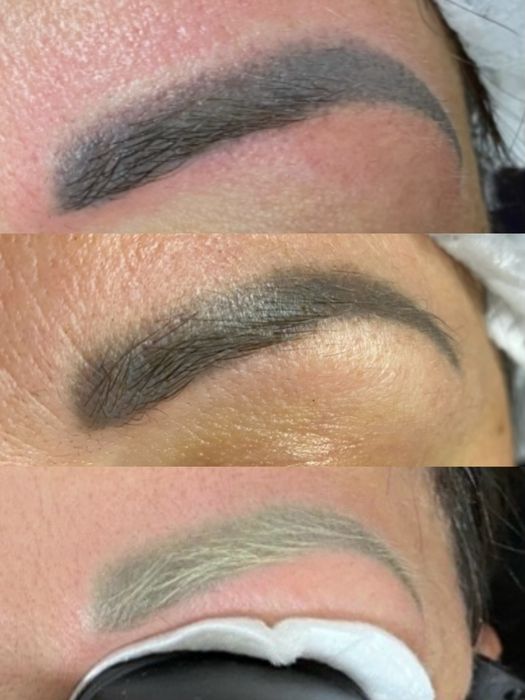 Видалення татуажа тату перманента лазером бровей стрелок губ ремувер