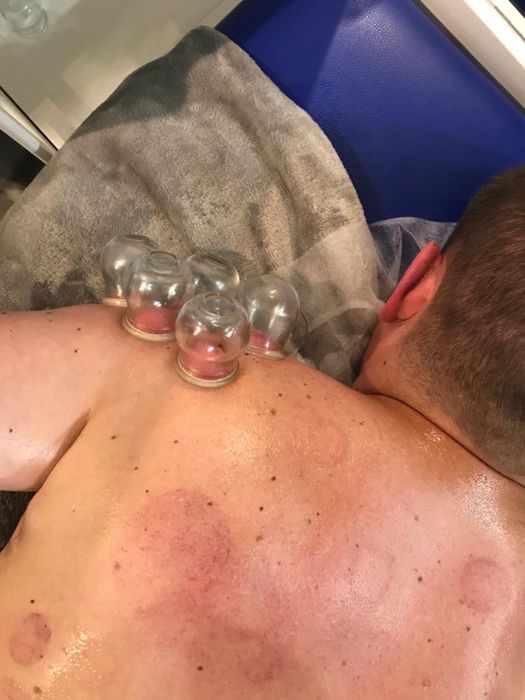 Stawianie baniek ogniowych lekarskich Dojazd do Pacjenta