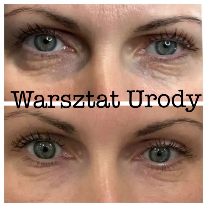 300zł= Kwas Hialuronowy Powiększenie Ust / Wolumetria 250z/ BOTOKS 200