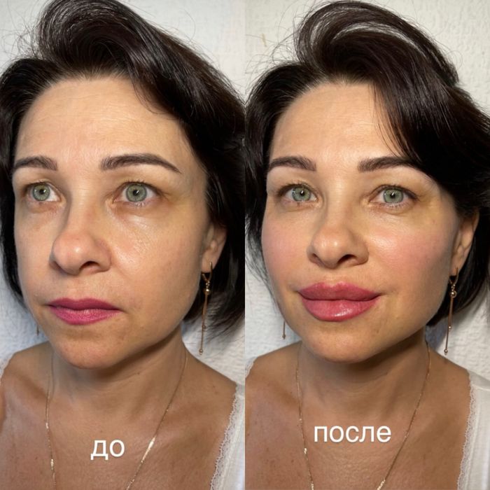 Увеличение губ.Контурная пластика.Ботокс.Биоревитализация.Липолитики.