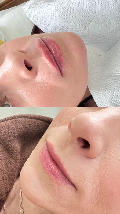 Увеличение губ 1800 грн Контурная пластика | Ботулинотерапия