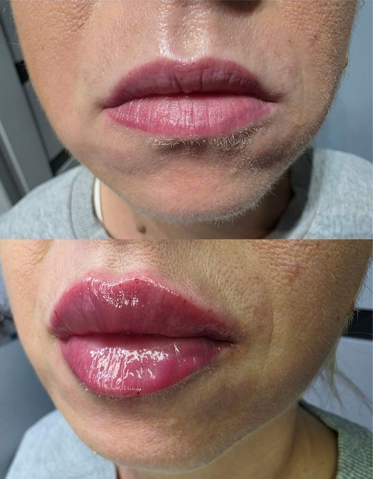 Promocja! Botox promocja 1 okolice 170zł do końca sierpnia