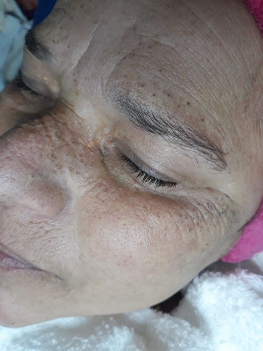 Limpeza De Pele