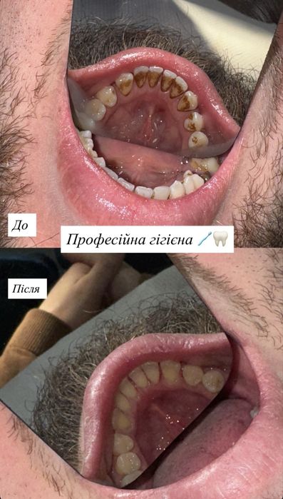 Стоматолог . Оболонь. Лікування карієсу, проф. гігієна , відбілювання