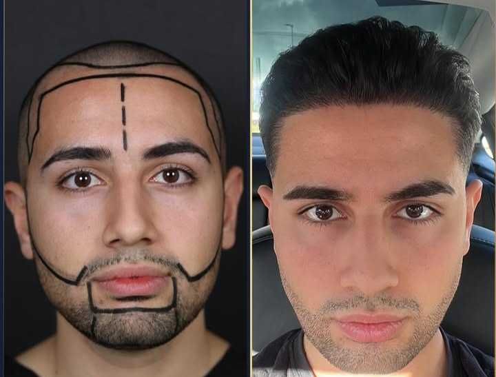 Transplante Capilar/Barba Istambul(Turquia) 2950€ TUDO INCLUIDO