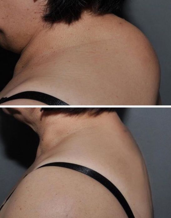 Лікування холки , корекція фігури