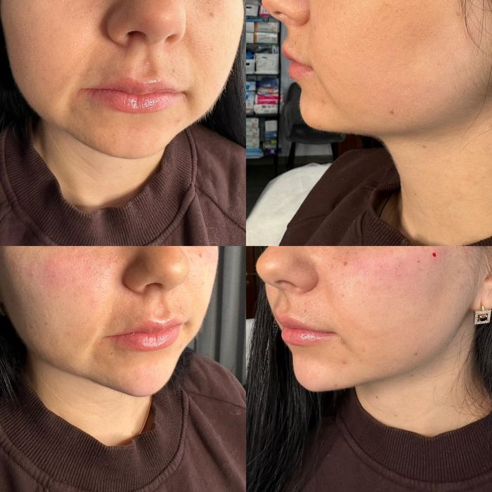 Косметолог. Губы . подбородок, углы нижней челюсти. Углы Джоли.