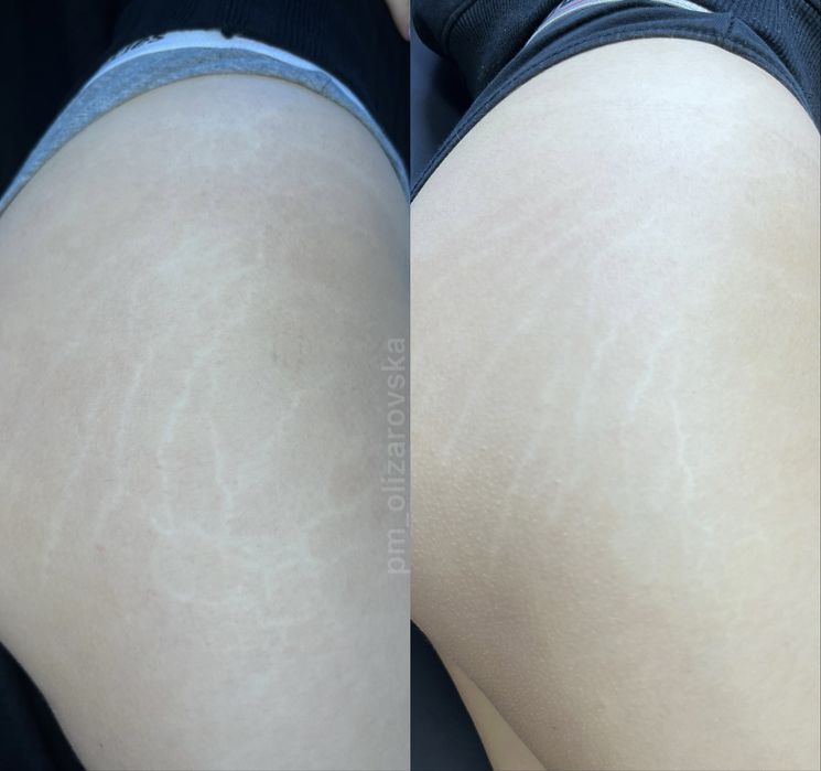 Мікронідлінг/Фракційна мезотерапія