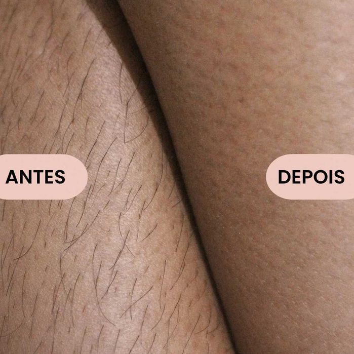 Depiladora a laser IPL