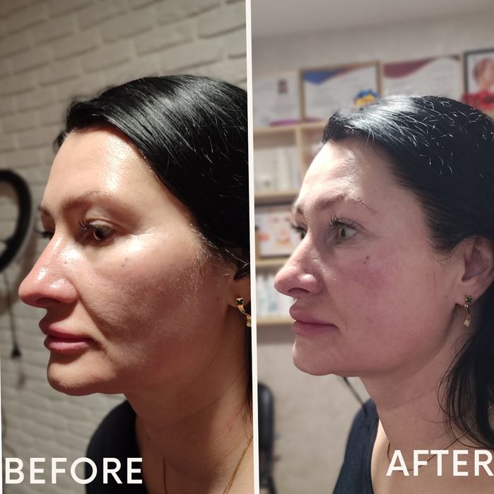 smas lifting без операційна підтяжка обличчя