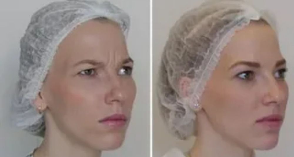 Ботулинотерапия! Гладкое личико! Ботокс!