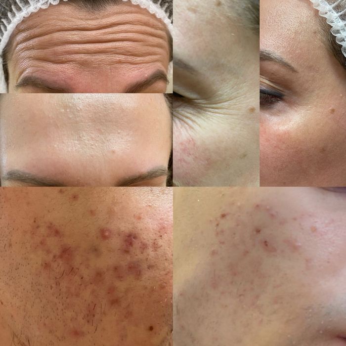 Косметолог. Ботокс, губи, векторний ліфтінг.