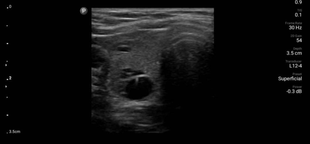 УЗД портативний Philips lumify L12-4