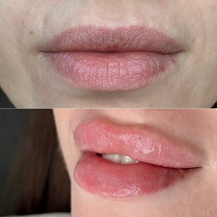 Увеличение губ косметолог, ботокс био- мезо- Черкассы