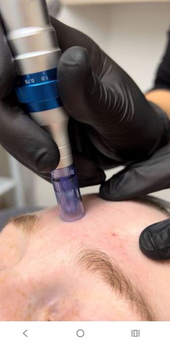 Hifu, microagulhamento, Microblading,