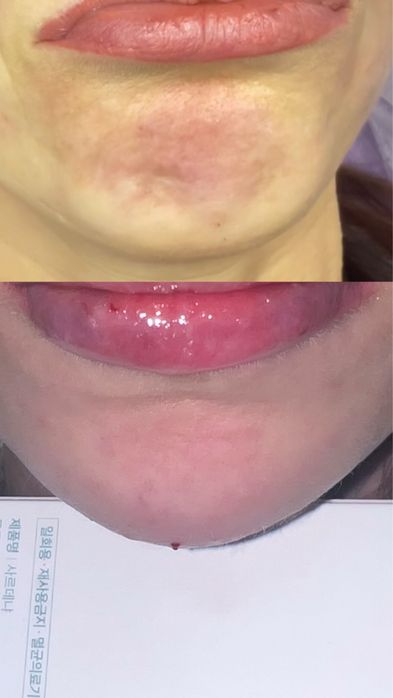 Збільшення губ 1500/3000 | лікар косметолог | моделі