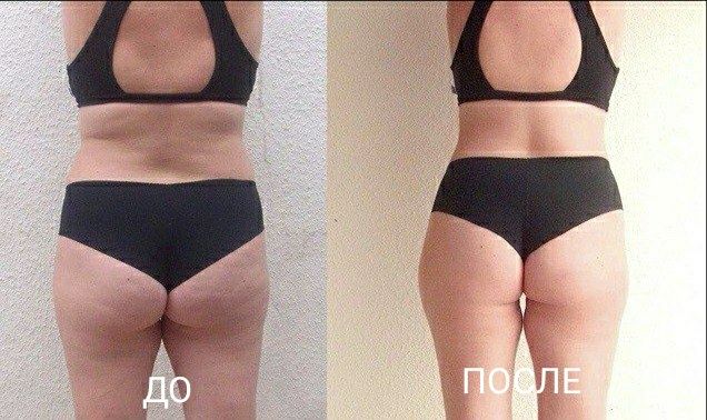 Массаж Антицеллюлитный, Классический, Лимфодренажный