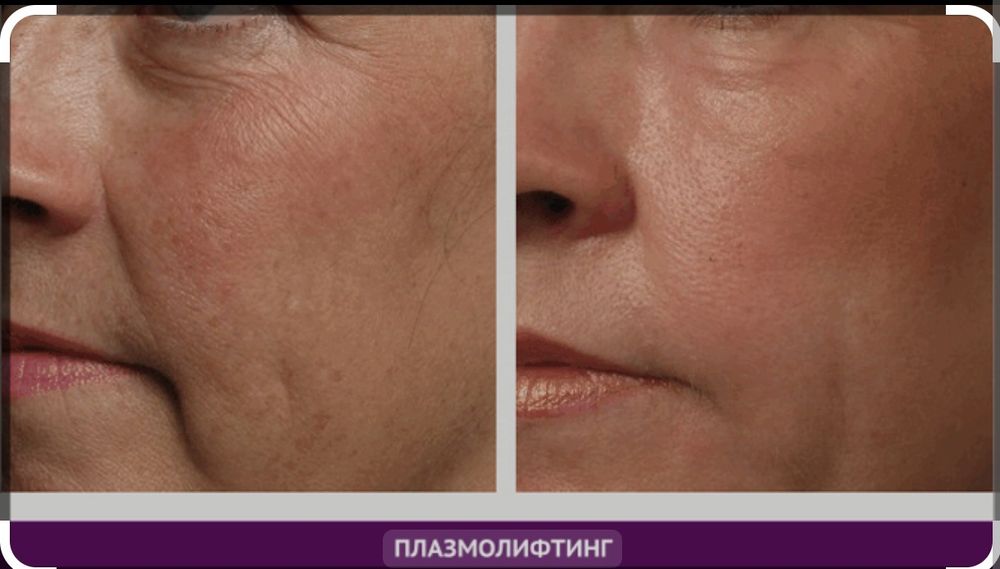 Плазмоліфтінг. Послуги косметолога.