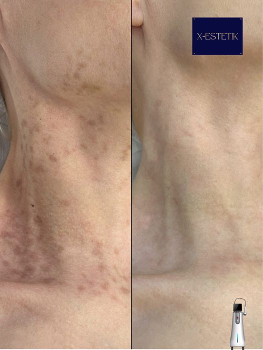 Zabieg laserem tulowym PROMOCJA 400 zł