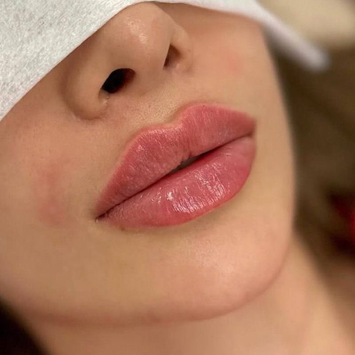 Збільшення вуст троєщина(фестивальний)