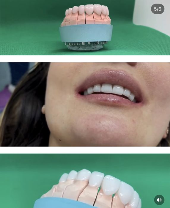 Керамічні вініри. Київ, 13500 грн . Акція! ВСЕ ВКЛЮЧЕНО!!! Е.max