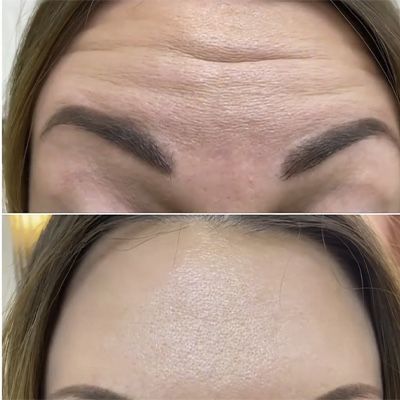 Терміново моделі на ботокс  2800 за 3 зони