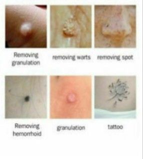 Plasma pen para estética