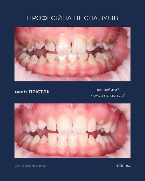 Стоматолог . Оболонь. Лікування карієсу, проф. гігієна , відбілювання