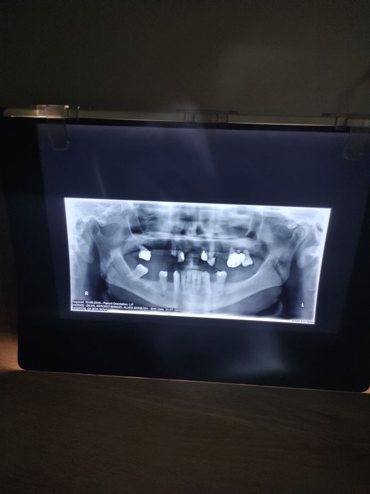 Negatoscopio  para RX dentario