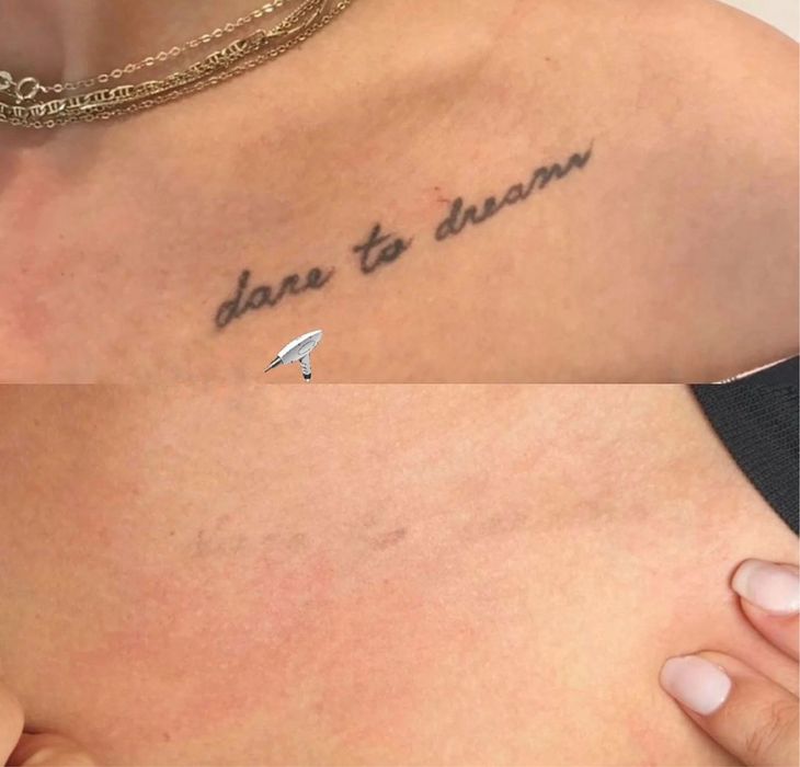 Видалення татуювання, перманенту