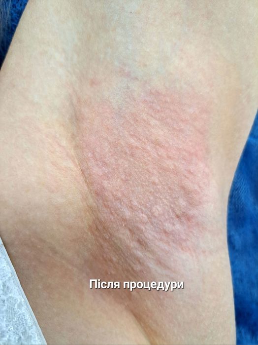 Електроепіляція, центр міста