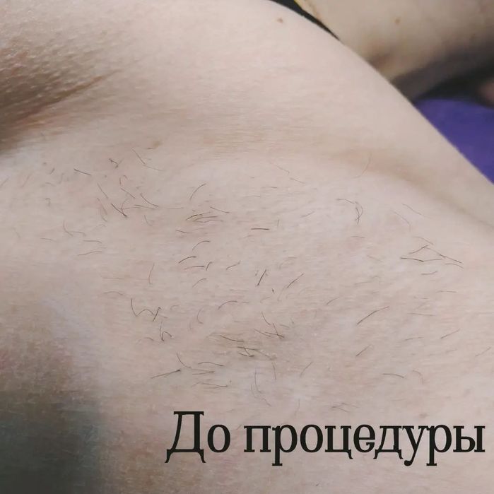 Электроэпиляция, центр города