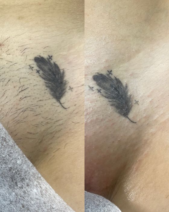 Электроэпиляция, поселок Котовского