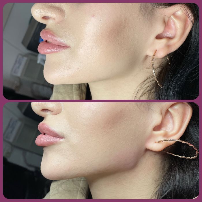 Збільшення губ , ботокс, косметолог