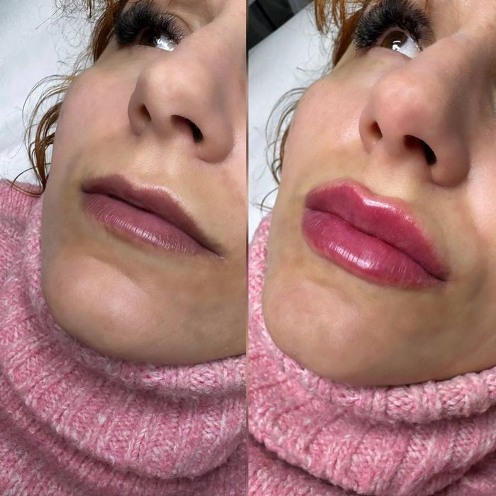 Акція!!Збільшення губ від 2500 грн,Ботокс