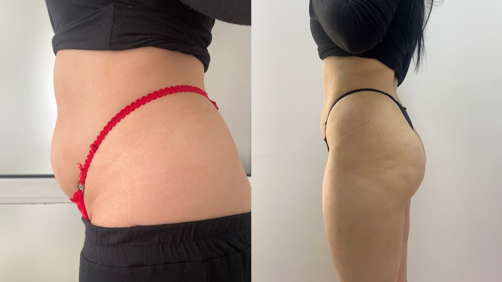 Лікування холки , корекція фігури