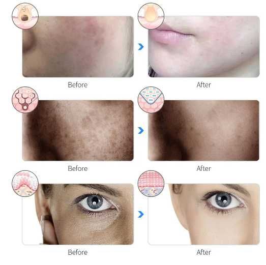 Máscara Facial LED
