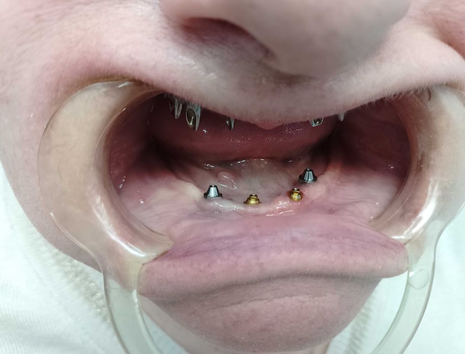 Стоматология. Протезирование .Имплантолгия