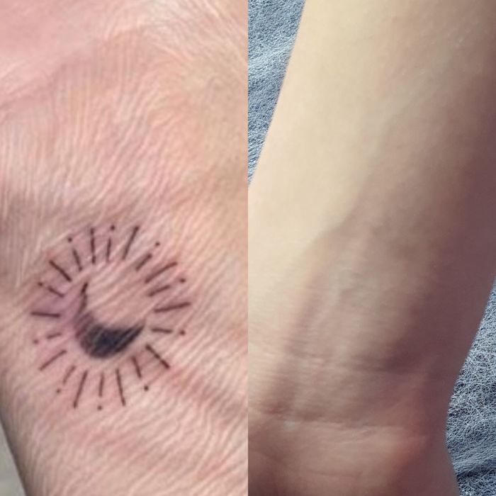 Удаление тату, Удаление татуажа, удаление перманента