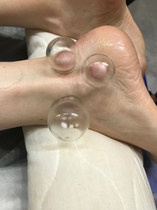 Stawianie baniek ogniowych lekarskich Dojazd do Pacjenta