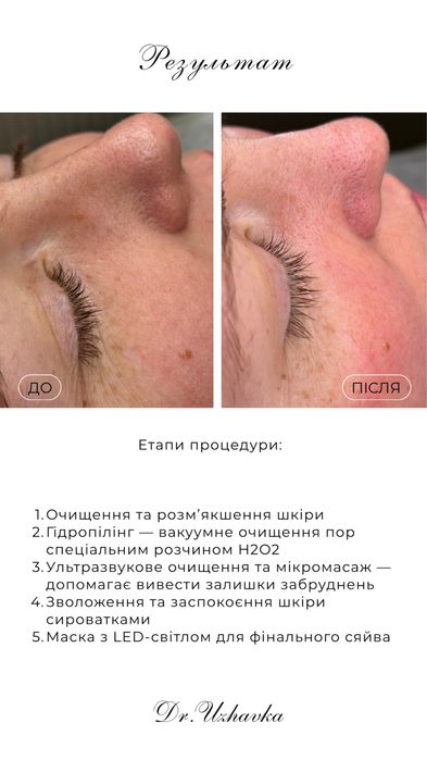 Губи,Полінуклеотиди Біоревіталізація, Ботокс, Пілінг, космтеолог Центр, Одеса
