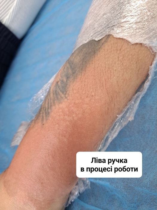 Електроепіляція, центр міста