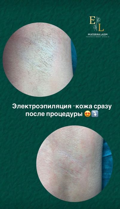 Лазерная эпиляция/Электроэпиляция/поселок Котовского