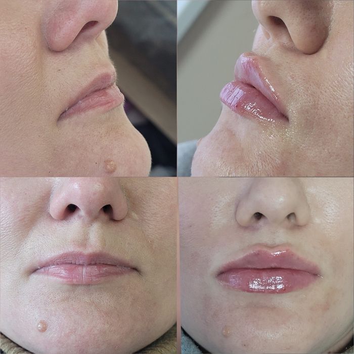 Збільшення губ КП губ Ботокс Дніпро