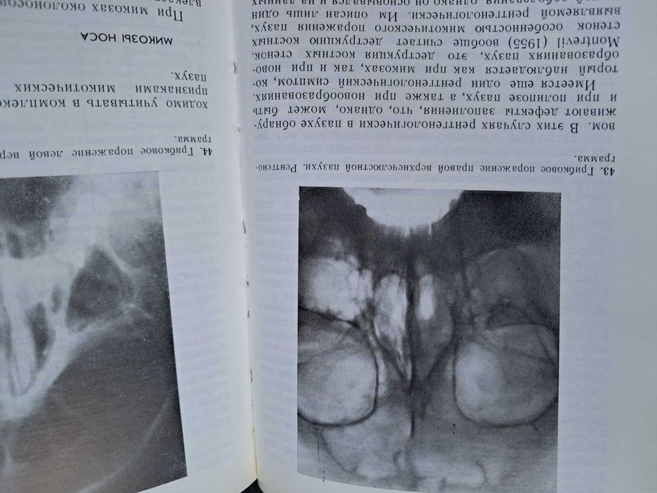 Микози в оториноларингологии