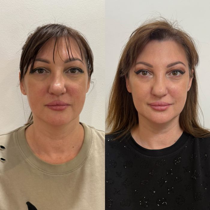 Увеличение губ. Контурная пластика. Губы. Ботокс.Нити.Фулфейс