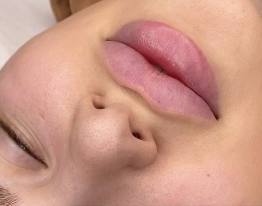 Powiększanie UST 300 zł /Btx/depilacja laserowa