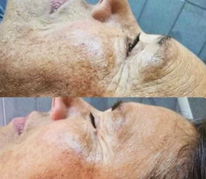 Depilação a laser, remoçao de tatuagem e peeling com valor justo