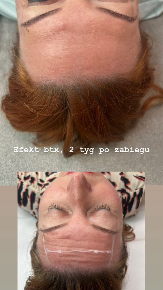 Powiększanie ust, botox , wolumetria, endermologia WARSZAWA 250 zł