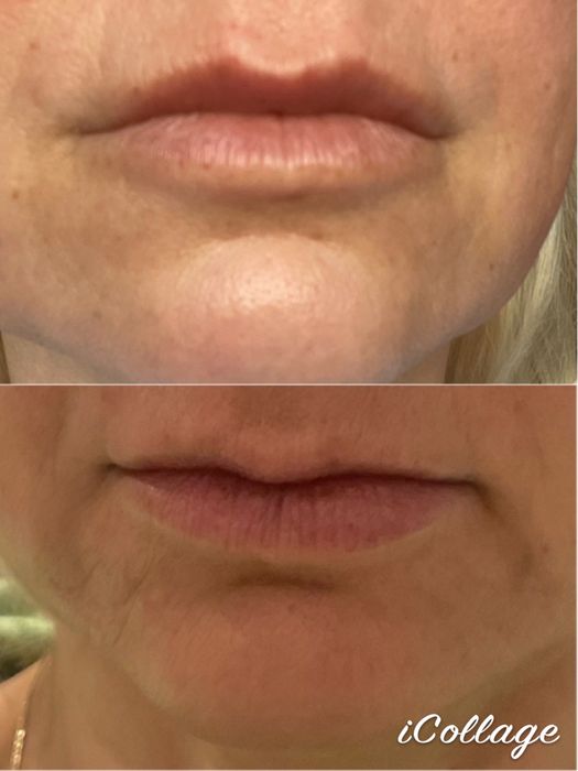 BTX , wygładzenie zmarszczek